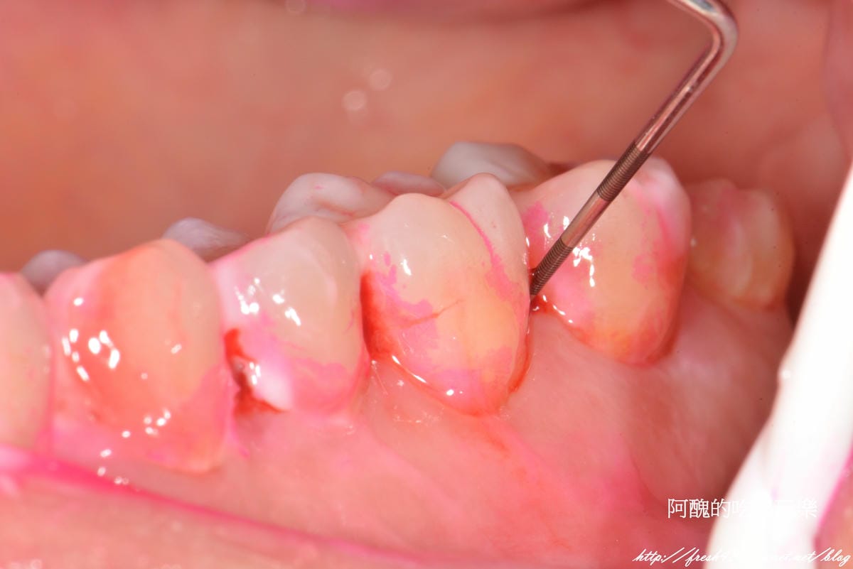 牙菌斑顯示劑
