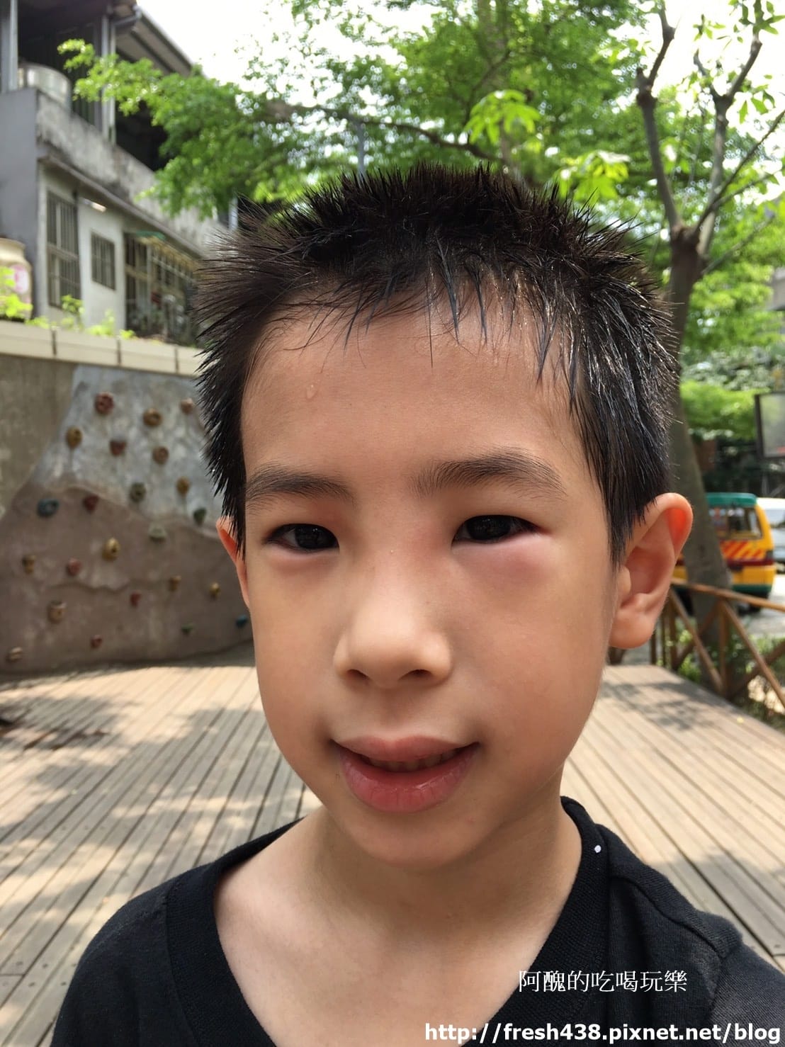 2017.5.3安安在牧人幼兒園活動被蚊蟲咬到眼睛 2017.5.3安安在牧人幼兒園活動被蚊蟲咬到眼睛